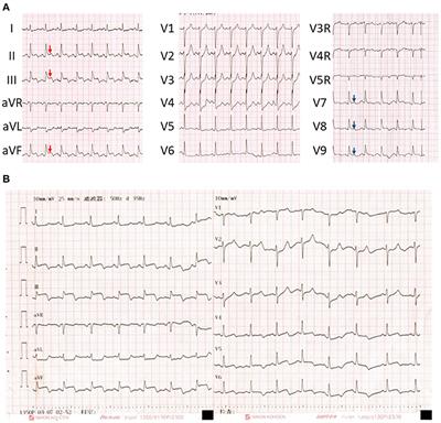 Case Report: Abnormal ECG in a Patient With Acute Pancreatitis